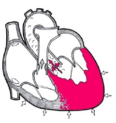 Гипертрофия левого желудочка сердца аномальное отклонение